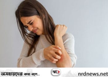 ঘামাচি থেকে কিভাবে মিলবে নিস্তার