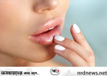 সহজে ঠোঁটের কালচে দাগ দূর করুন